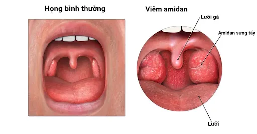 Viêm amidan mãn tính kéo dài làm tăng nguy cơ mắc viêm họng hạt